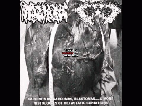 Hydrocephalus : Hydrocephalus - Carcinomas of Unknown Primary Origin